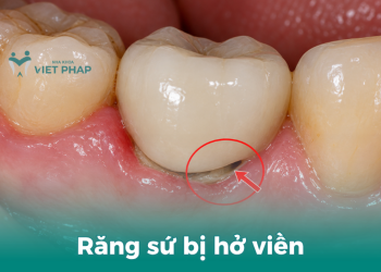 Răng sứ bị hở viền