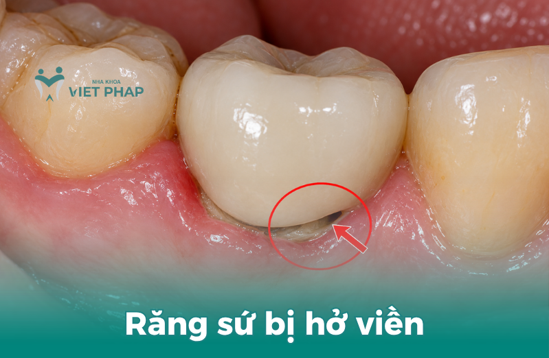 Răng sứ bị hở viền