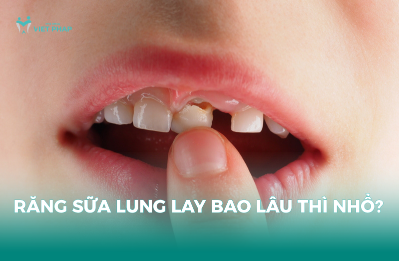 Răng sữa lung lay bao lâu thì nhổ