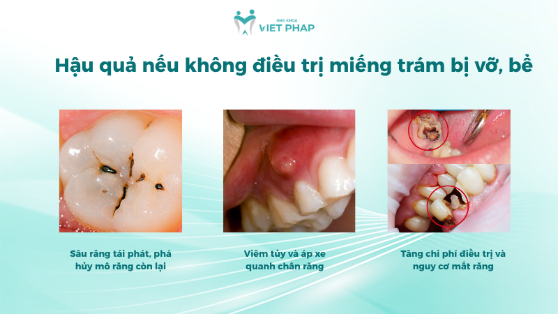 Hậu quả nếu không điều trị miếng trám bị vỡ, bể