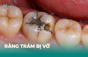 Răng trám bị vỡ