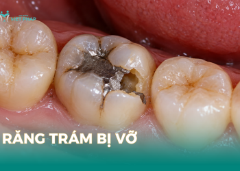 Răng trám bị vỡ