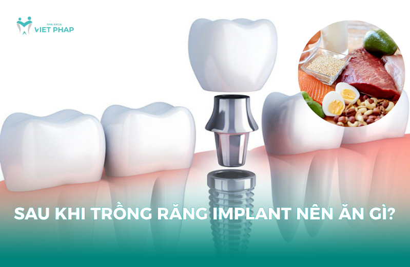 Sau khi trồng răng implant nên ăn gì