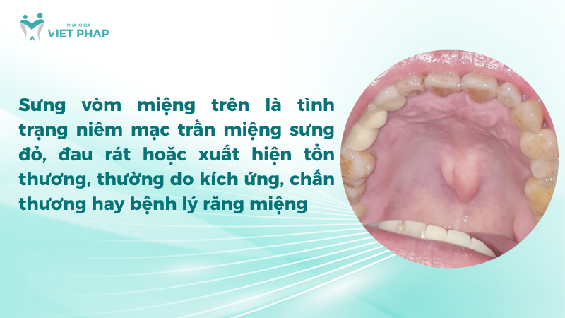 sung vom mieng tren 1 Sưng vòm miệng trên là tình trạng niêm mạc trần miệng sưng đỏ, đau rát hoặc xuất hiện tổn thương, thường do kích ứng, chấn thương hay bệnh lý răng miệng