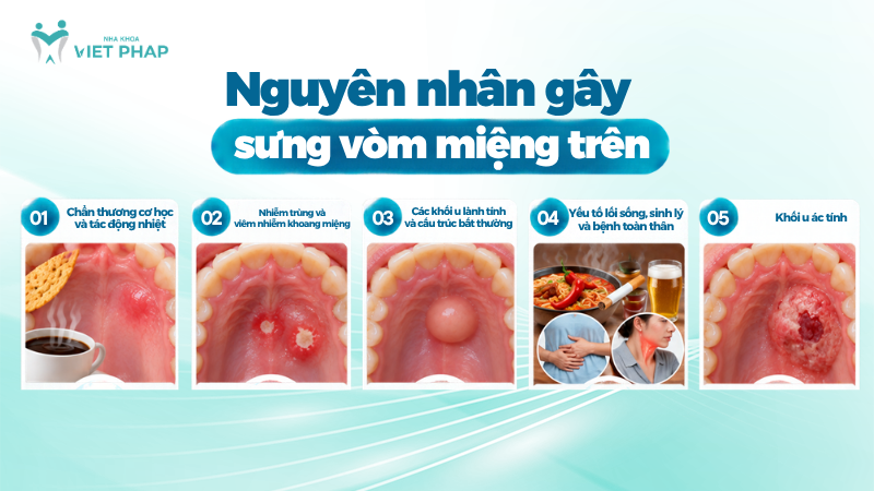sung vom mieng tren 2 Nguyên nhân gây sưng vòm miệng trên