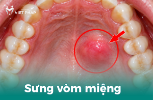 Sưng vòm miệng trên