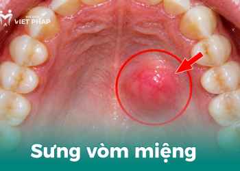 Sưng vòm miệng trên
