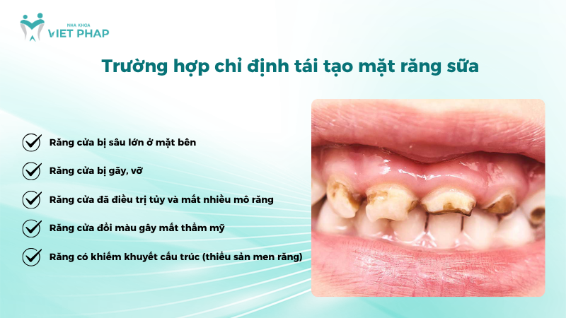 tai tao mat rang sua 2 Các trường hợp răng cửa sữa bị sâu lớn, gãy vỡ, đổi màu hoặc khiếm khuyết cấu trúc