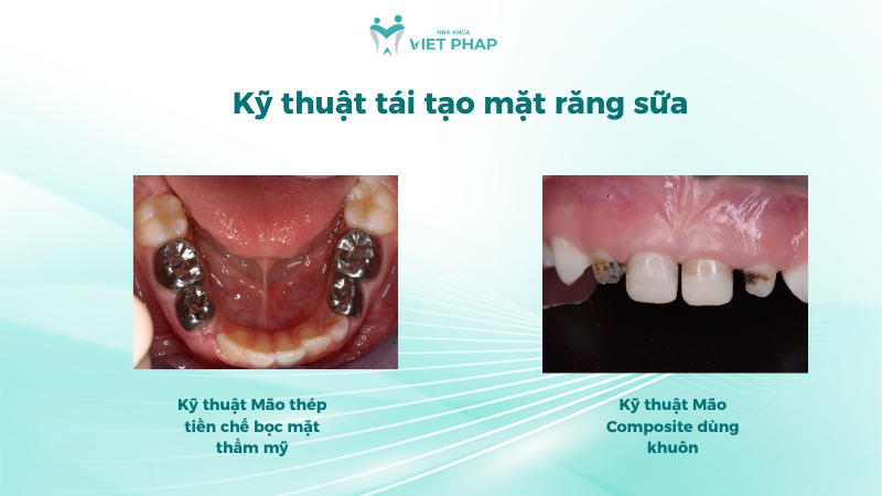 tai tao mat rang sua 4 Minh họa phục hồi bằng mão thép và mão composite dùng khuôn cho răng sữa
