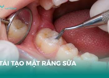 Thăm khám răng miệng và tái tạo mặt răng sữa tại Nha khoa Việt Pháp