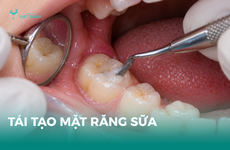 Thăm khám răng miệng và tái tạo mặt răng sữa tại Nha khoa Việt Pháp