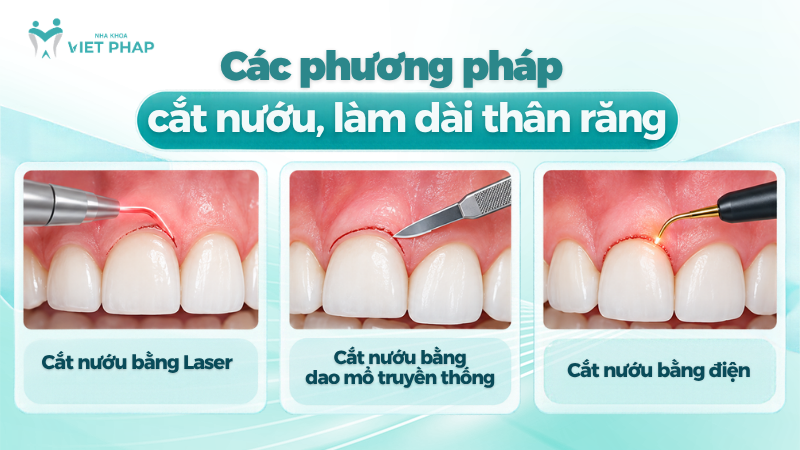 Các phương pháp cắt nướu, làm dài thân răng
