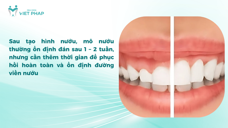 Sau tạo hình nướu, mô nướu thường ổn định đán sau 1 – 2 tuần, nhưng cần thêm thời gian để phục hồi hoàn toàn và ổn định đường viền nướu
