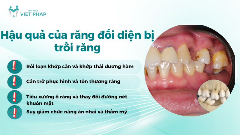 tao hinh nuou Hậu quả của răng đối diện bị trồi răng