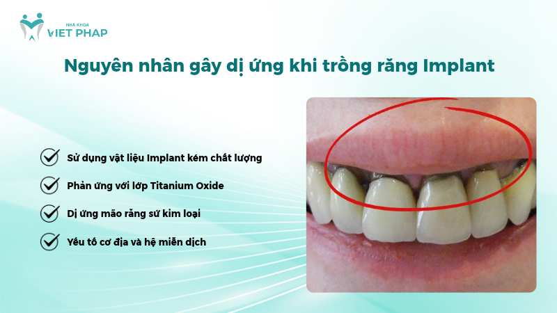 Nguyên nhân gây dị ứng khi trồng răng Implant