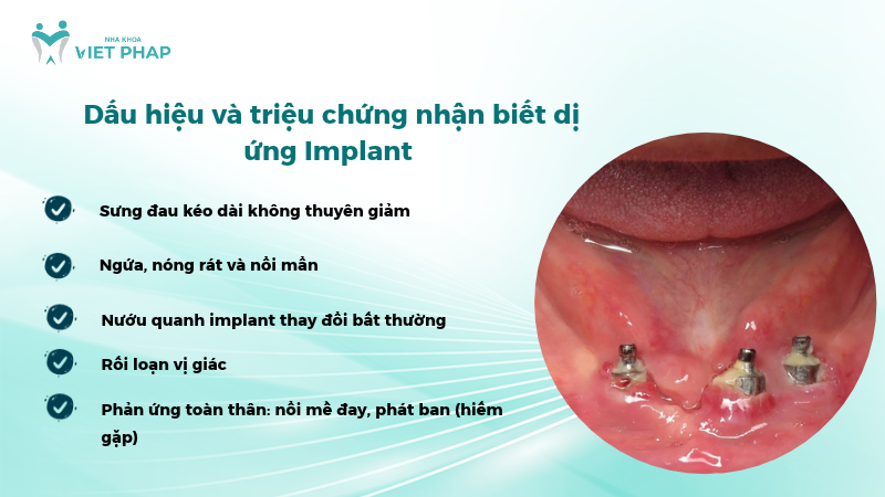 Dấu hiệu và triệu chứng nhận biết dị ứng Implant