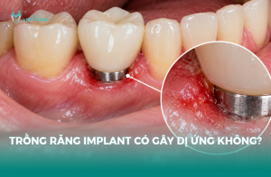 trồng răng implant có gây dị ứng không
