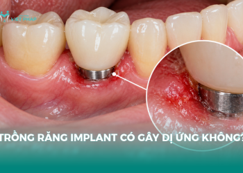 trồng răng implant có gây dị ứng không