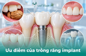 Ưu điểm của trồng răng implant
