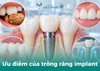 Ưu điểm của trồng răng implant
